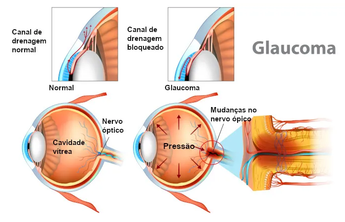 Compreenda o Glaucoma: Causas, Sintomas e Tratamentos