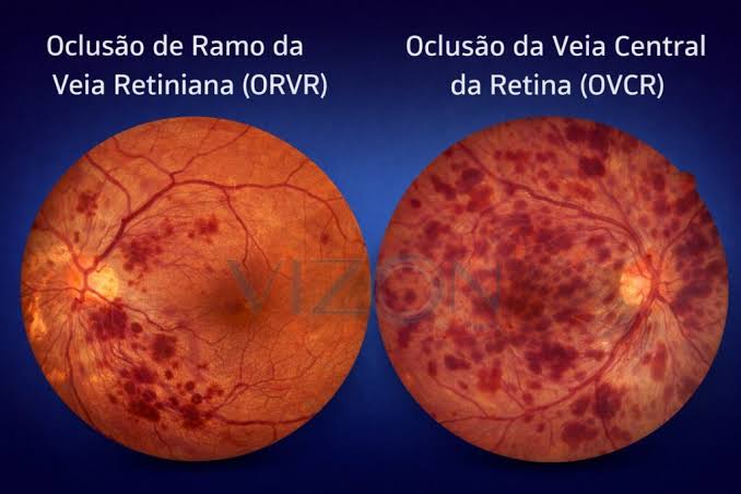 Entenda a Oclusão Vascular Retiniana: Causas e Tratamentos