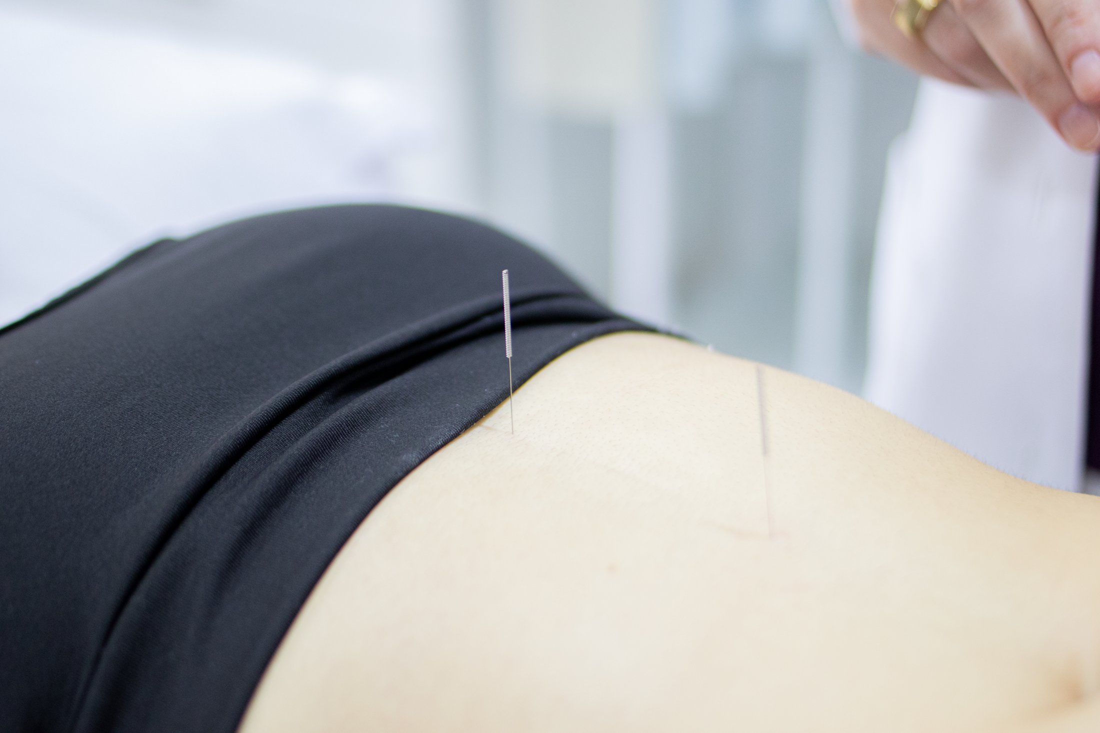 Acupuntura: para que serve, benefícios e como funciona